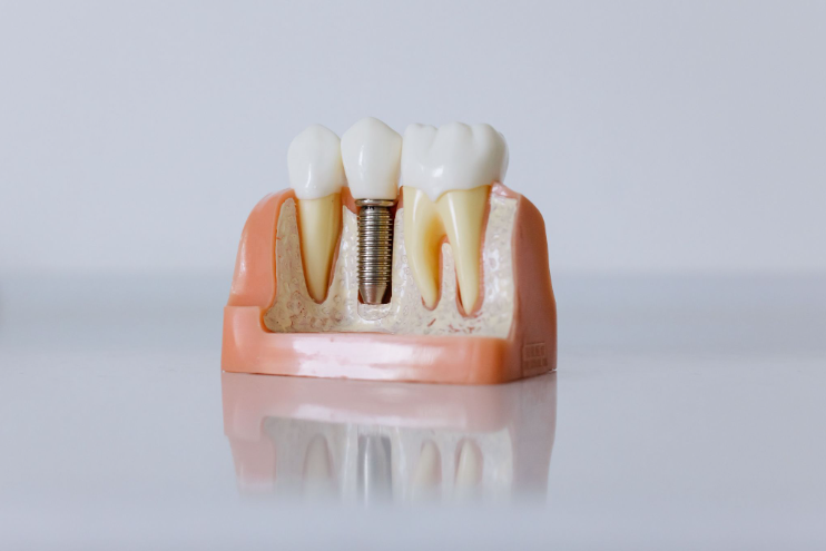 Illustration d’un implant dentaire